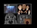 Лекция: «Роль МРТ при  патологии тазобедренного сустава – что должен знать рентгенолог»