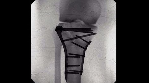 Bicondylar Tibial Plateau  Fractures   (A touch Surgery - Apps TM) )
