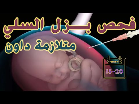 فحص بزل السلى (فحص السائل السلوي) | Amniocentesis