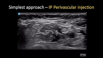 US-guided Axillary Brachial Plexus Block - the Simple Guide