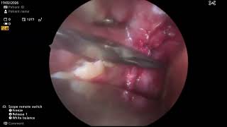 PARAPHARYGEAL MASS EXCISION 3