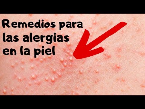 4 Remedios caseros para tratar la alergia en la piel