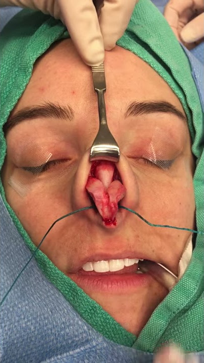 Anatomy of Nose