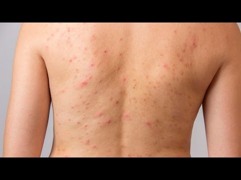 Acne in the back and chest causes and natural treatments