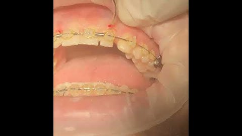 What is Gingivectomy?