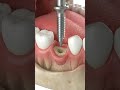 3D Tooth Implant Process – From Missing Tooth to Perfect Smile 🦷✨
