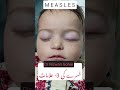 Symptoms of Measles #measles #khasra