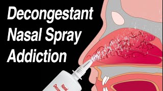 Decongestant Nasal Spray Addiction (Afrin, Zicam, Sinex, Neo-Synephrine, etc)