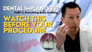 Dental Implants 101: What You NEED to Know! Part 3 (Everything Bone Grafting)