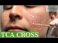 Acne Scar Removal with TCA Cross 80% - Los Angeles - Dr. Ben Behnam