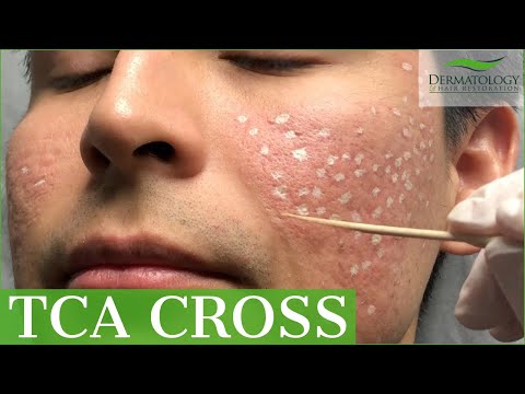 Acne Scar Removal with TCA Cross % - Los Angeles - Dr. Ben Behnam