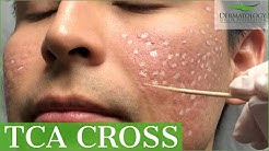 Acne Scar Removal with TCA Cross 80% - Los Angeles - Dr. Ben Behnam