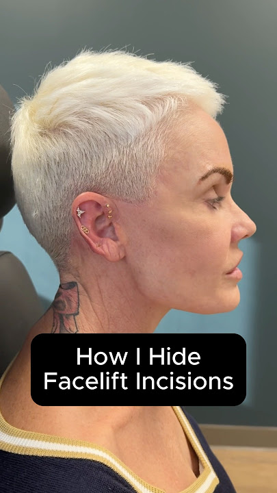 How I Hide Facelift Incisions