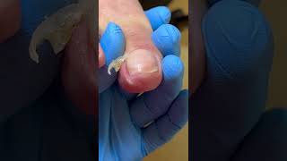 Silky Smooth Cut Away Ingrown Nails ~ Decompression #nails #satisfying