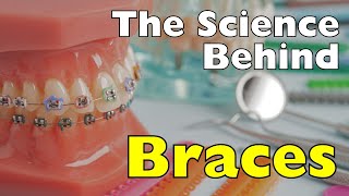 What Braces Really Do to Your Teeth