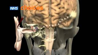 Glue Ear An Animation