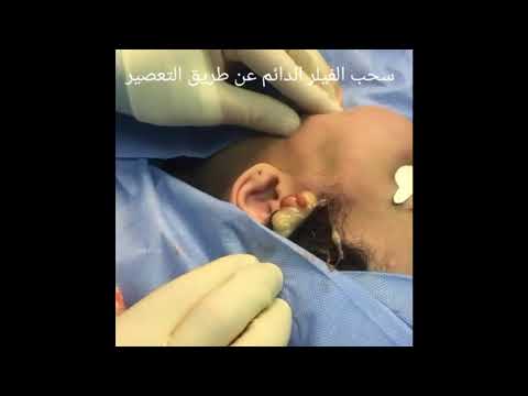 سحب الفيلر الدائم من الوجه