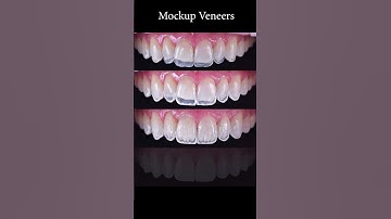 Mockup veneers