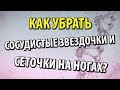 Сосудистые звездочки и сеточки на ногах. Как убрать