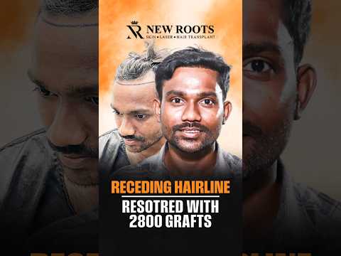My Brother Recommended This Clinic! | 2800 Grafts #shorts #hairtransplant #raipur
