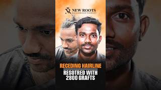 My Brother Recommended This Clinic! | 2800 Grafts #shorts #hairtransplant #raipur