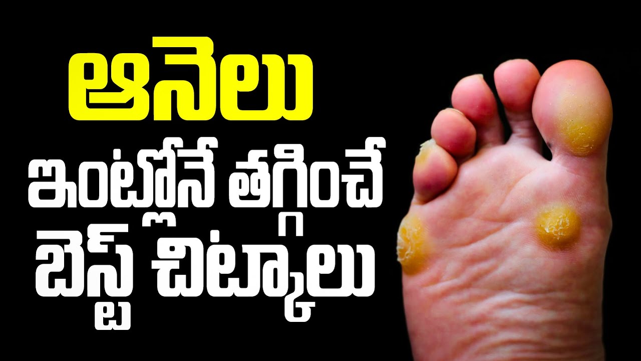 ఆనెలు ఇంట్లోనే తగ్గించే బెస్ట్ చిట్కాలు| Foot Corns & Treatments | The Natural Cure Anelu #footcorn