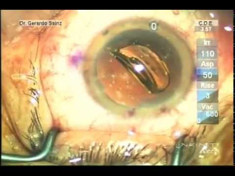 Lentes Intraoculares Premium - Dr Gerardo Sainz de...