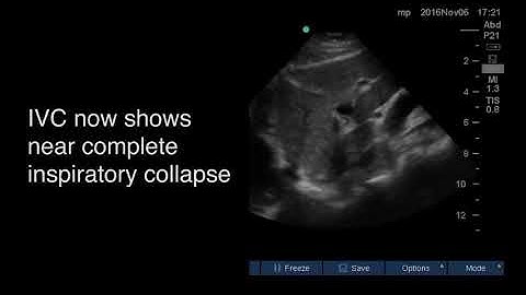 IVC Ultrasound