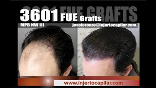 3601FUE Grafts.NW III.Frontal/temp.peaks restoration. Atopic dermatitis. Injertocapilar.com2300/2018