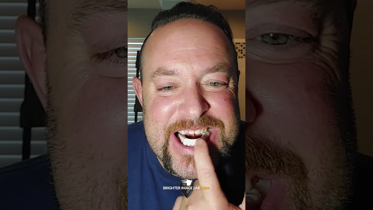 #shorts Pop-On Veneers WATCH BEFORE BUYING Real Client Review