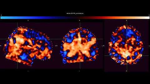 Changes in Default Mode Network (DMN) connectivity with a sequence of ten volumes  window