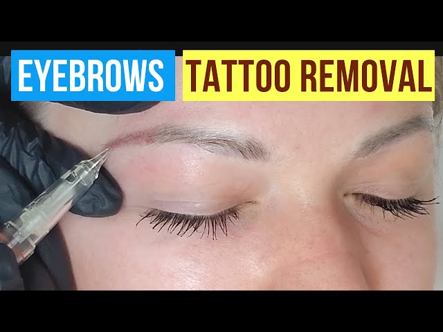 Discover more than 177 tattoo removal tool