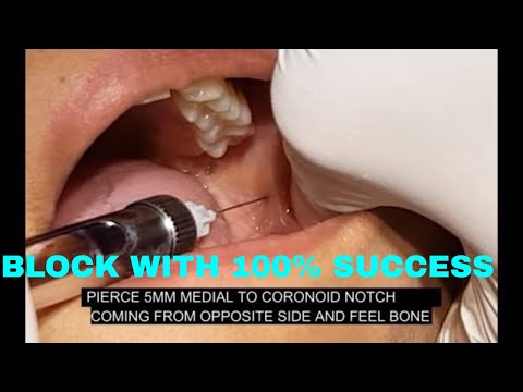 INFERIOR ALVEOLAR NERVE BLOCK|INFERIOR ALVEOLAR BLOCK|INDIRECT TECHNIQUE