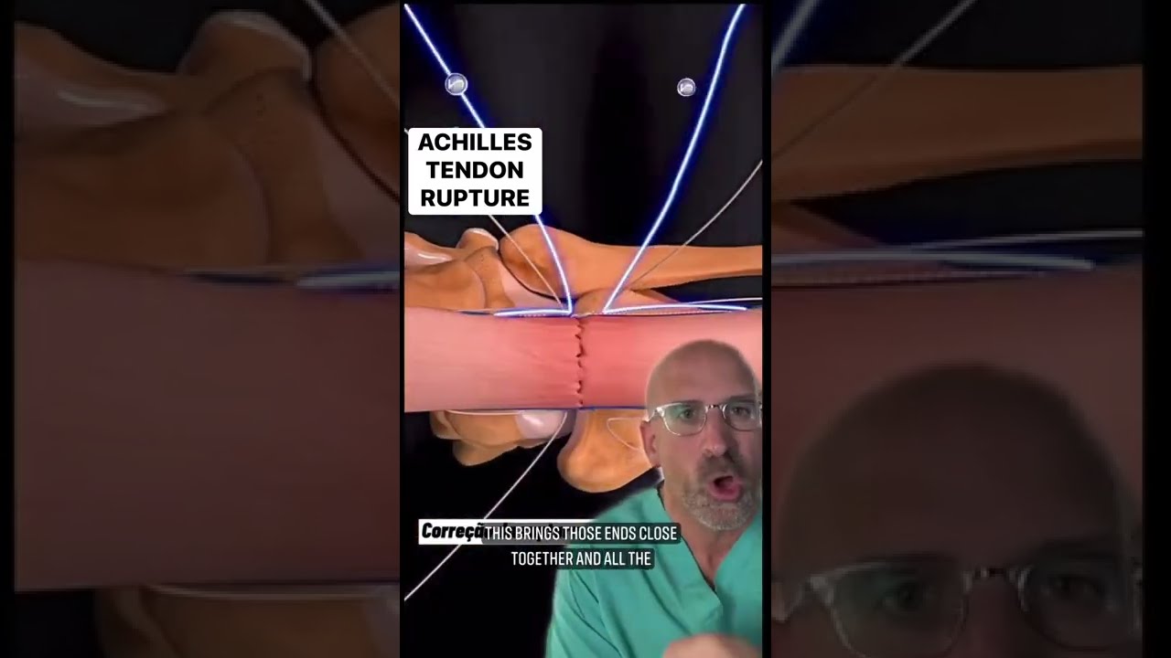 Achilles Tendon Rupture And Repair