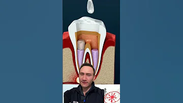 ¿Por qué los dentistas no hacen endodoncias?