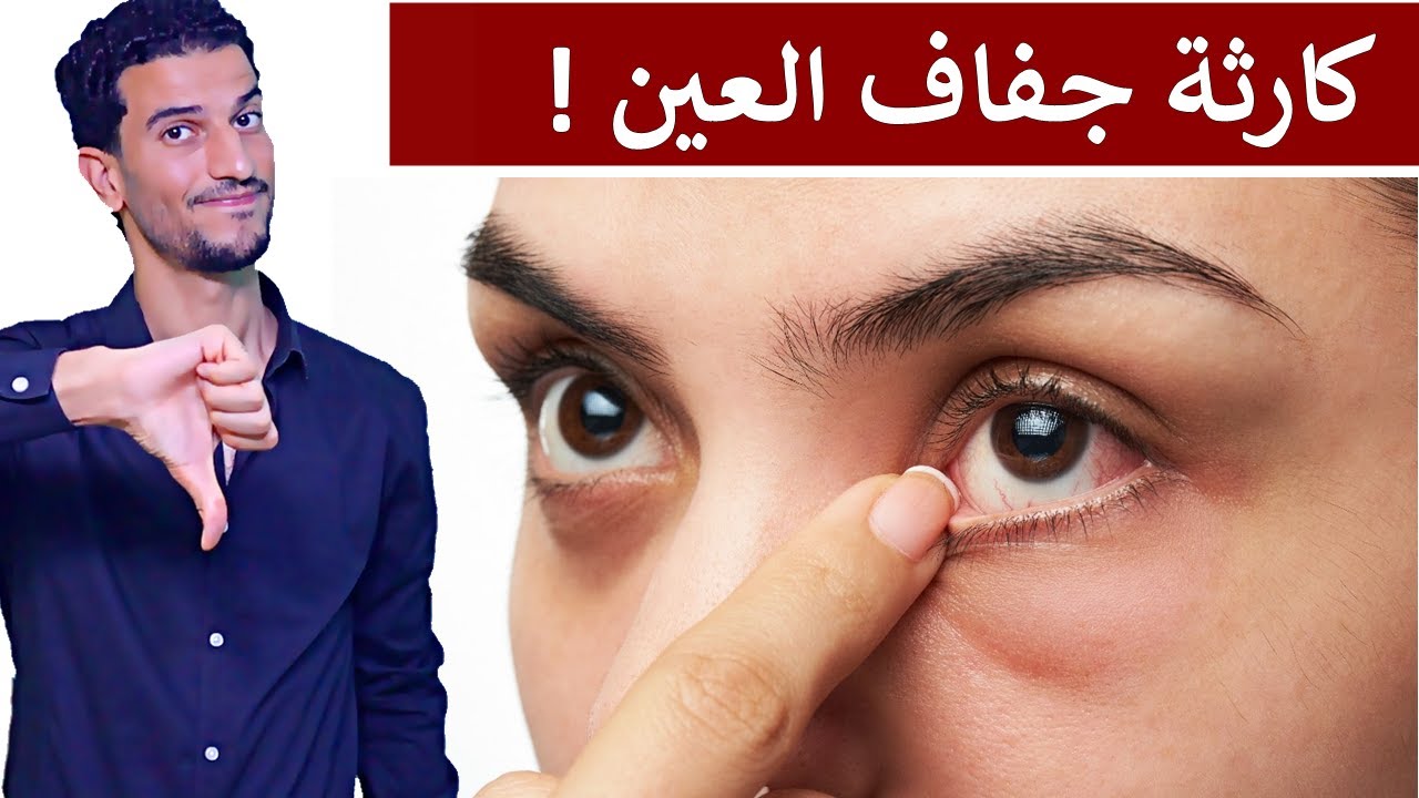 احذر جفاف العين خطر ! + افضل علاج فوري لجفاف واحمرار العين