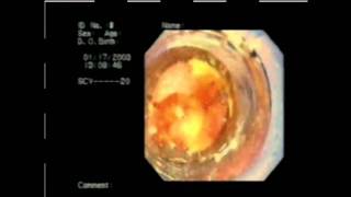 Endoscopy for Surgeons PG: Discussion and Endoscopic Clip