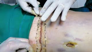 Closure of tummy tuck incesion without sutures قفل جرح شد البطن بدون خياطة