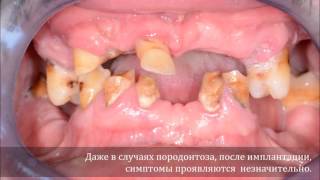 Полное восстановление челюсти Straumann имплантами по методике Pro – arch Полное восстановление челюсти Straumann имплантами по методике Pro – arch