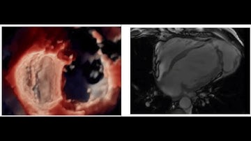 Left Ventricle Dyskinesia: 3D TrueVue & MRI