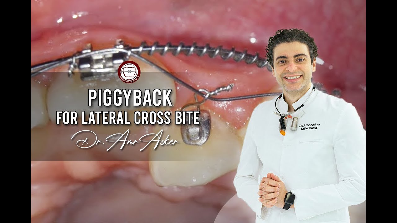 Double wire traction in orthodontics (piggyback) for lateral cross bite