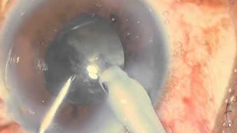 Horizontal Chop Phaco Soosan Jacob 2 2 min with audio
