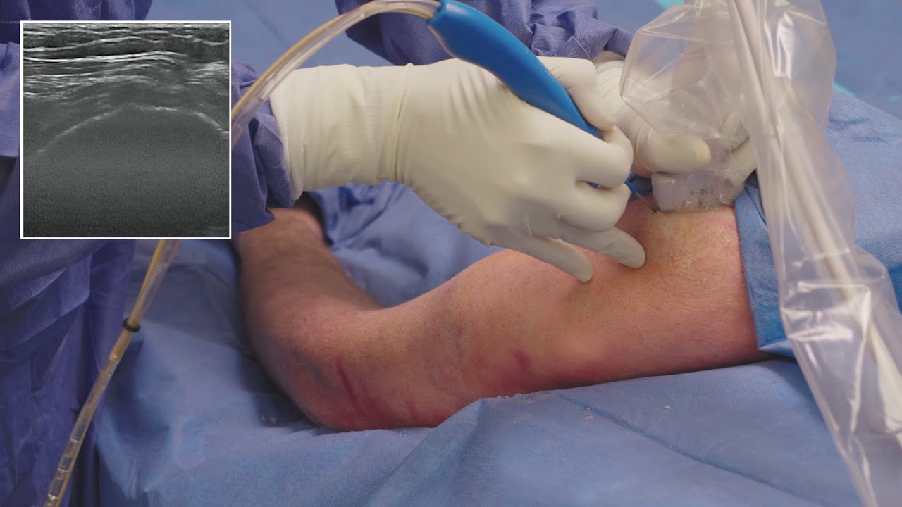 TenJet Shoulder Minimally Invasive Tenotomy Procedure YouTube