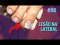 LESÃO NA LATERAL ( "NAIL LOVERS" )#PODOLOGOMAURELIO #PODOLOGIA#UNHAENCRAVADA