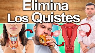 Cómo Eliminar Los Quistes De Ovario? - Soluciones Avanzadas Para Regular Las Hormonas