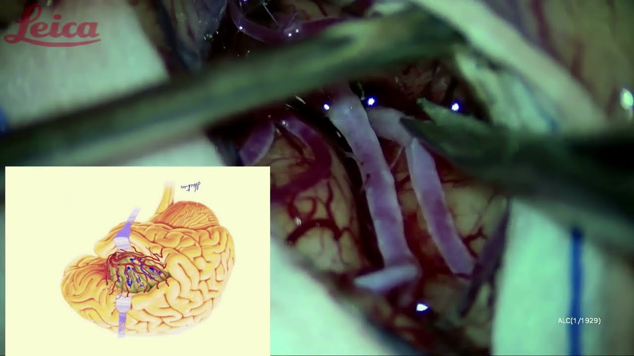 🧠 Transsylvian approach