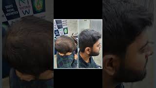 Scalp Micropigmentation