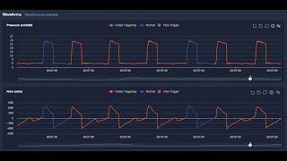 Failed Triggering Breath (Ineffective effort) because of ventilator over assistance
