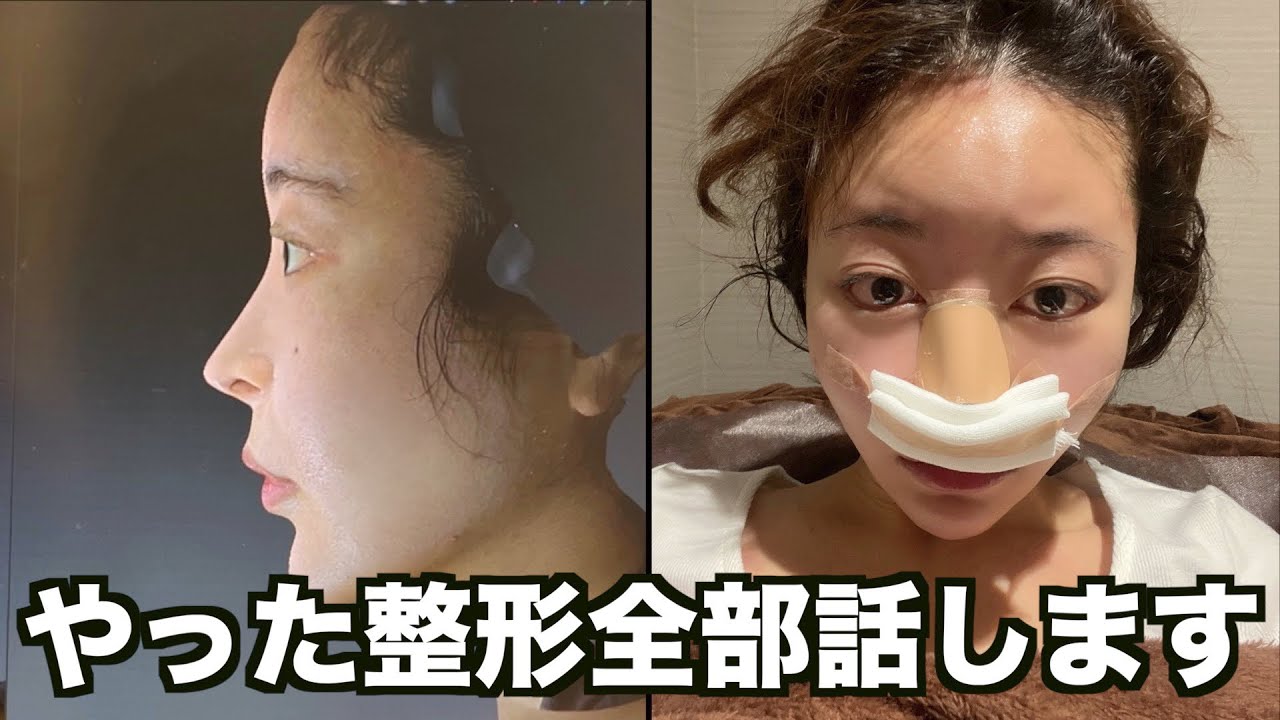 【整形公開】整形しました!今回の整形について全てお話します【三年食太郎】 - YouTube