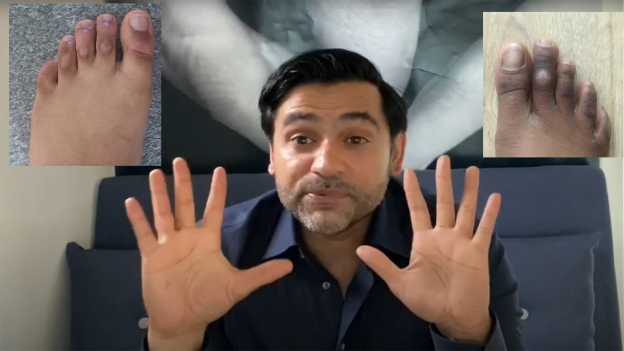 Foot Corn Removal Surgery for Corns and lesion on Top of the toes YouTube